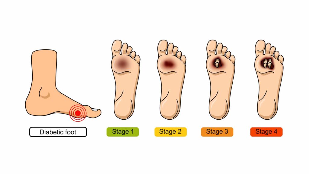 Fasi degenerative del piede diabetico